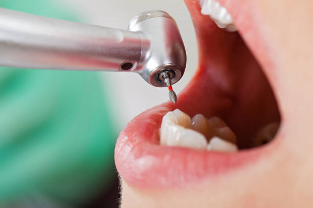 Best Dental Abscess Treatment in Chester, IL